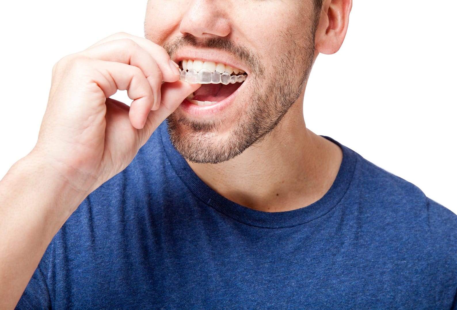 man-putting-in-Invisalign